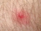 A dangerous red bug causing a severe tick bite warning for families