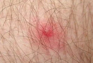 A dangerous red bug causing a severe tick bite warning for families
